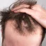 perda_cabelo.jpg